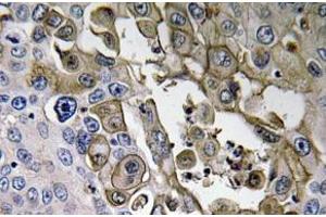Immunohistochemistry (IHC) analyzes of RAGE antibody in paraffin-embedded human lung carcinoma tissue. (RAGE 抗体)