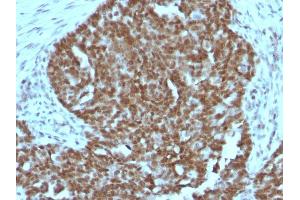 Formalin-fixed, paraffin-embedded human Ovarian carcinoma stained with Nucleolin MAb (364-5 + NCL/902). (Nucleolin 抗体)