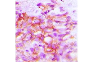 Immunohistochemical analysis of TRP2 staining in human breast cancer formalin fixed paraffin embedded tissue section. (DCT 抗体  (Center))