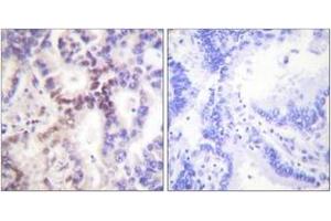 Immunohistochemistry analysis of paraffin-embedded human lung carcinoma tissue, using p15 INK Antibody. (CDKN2B 抗体  (AA 89-138))