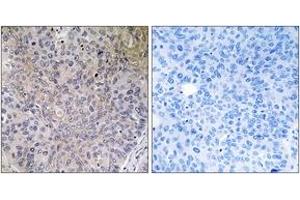 Immunohistochemistry analysis of paraffin-embedded human lung carcinoma tissue, using NDUFS7 Antibody. (NDUFS7 抗体  (AA 164-213))