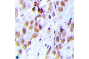 Immunohistochemical analysis of LSm4 staining in human breast cancer formalin fixed paraffin embedded tissue section. (LSM4 抗体)