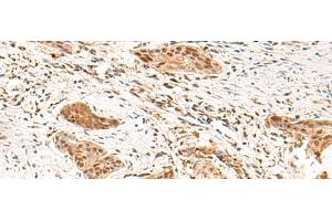 Immunohistochemistry of paraffin-embedded Human esophagus cancer tissue using TEAD3 Polyclonal Antibody at dilution of 1:50(x200) (TEAD3 抗体)