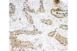 Anti-Caspase-3(P10),  IHC(P) IHC(P): Human Lung Cancer Tissue (Caspase 3 抗体  (C-Term))