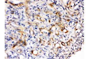 Nestin was detected in paraffin-embedded sections of human melanoma tissues using rabbit anti- Nestin Antigen Affinity purified polyclonal antibody at 1 μg/mL. (Nestin 抗体  (N-Term))