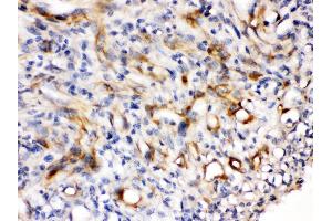 Nestin was detected in paraffin-embedded sections of human melanoma tissues using rabbit anti- Nestin Antigen Affinity purified polyclonal antibody at 1 μg/mL.