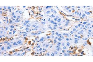 Immunohistochemistry of paraffin-embedded Human lung cancer tissue using MFN1 Polyclonal Antibody at dilution 1:60 (MFN1 抗体)