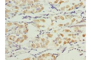 Immunohistochemistry of paraffin-embedded human gastric cancer using ABIN7171717 at dilution of 1:100 (SMG6 抗体  (AA 251-511))