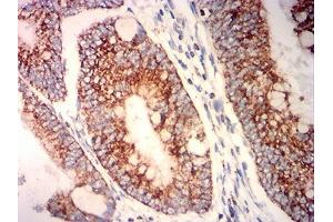 Immunohistochemical analysis of paraffin-embedded rectum cancer tissues using PLA2G7 mouse mAb with DAB staining. (PLA2G7 抗体  (AA 22-441))