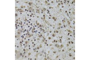 Immunohistochemistry of paraffin-embedded human liver cancer using INTS6 Antibody. (INTS6 抗体)