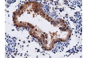 Immunohistochemical staining of paraffin-embedded Adenocarcinoma of Human endometrium tissue using anti-AK5 mouse monoclonal antibody. (Adenylate Kinase 5 抗体)
