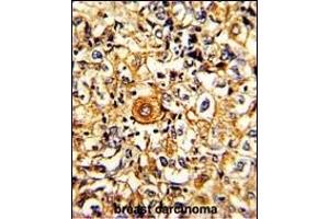 Formalin-fixed and paraffin-embedded human breast carcinoma with PTAR1 Antibody (Center), which was peroxidase-conjugated to the secondary antibody, followed by DAB staining. (PTAR1 抗体  (AA 60-89))