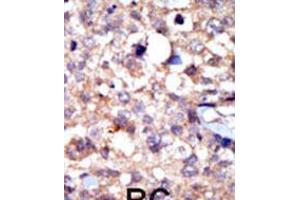Formalin-fixed and paraffin-embedded human cancer tissue reacted with the primary antibody, which was peroxidase-conjugated to the secondary antibody, followed by AEC staining. (ABL1 抗体  (C-Term))