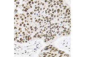 Immunohistochemistry of paraffin-embedded human lung cancer using BAF60a antibody. (SMARCD1 抗体)