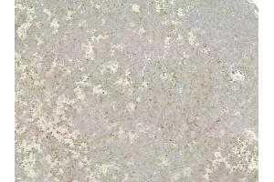 ABIN6259529 and ABIN6273980 at 1/100 staining human melanoma by IHC-P.