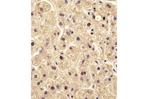(ABIN6242566 and ABIN6578504) staining PGM1 in human liver tissue sections by Immunohistochemistry (IHC-P - paraformaldehyde-fixed, paraffin-embedded sections). (Phosphoglucomutase 1 抗体  (AA 251-282))