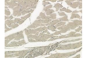 ABIN6265040 and ABIN6273317 at 1/100 staining human tongue carcinoma by IHC-P. (SGCG 抗体  (C-Term))
