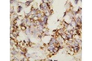 IHC-P: N-Cadherin antibody testing of human ovary cancer tissue (N-Cadherin 抗体  (AA 701-714))