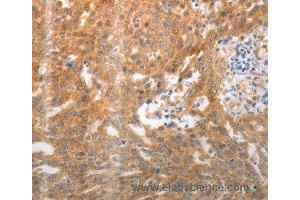 Immunohistochemistry of Human ovarian cancer using NQO1 Polyclonal Antibody at dilution of 1:25 (NQO1 抗体)
