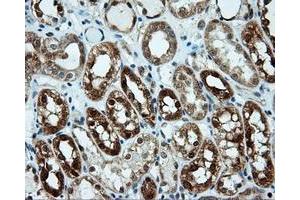 Immunohistochemical staining of paraffin-embedded Carcinoma of liver tissue using anti-LIPG mouse monoclonal antibody. (LIPG 抗体)