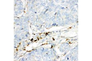 Anti- HEXB antibody, IHC(P): Human Lung Cancer Tissue