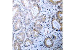 Immunohistochemical analysis of Calreticulin staining in human colon cancer formalin fixed paraffin embedded tissue section.