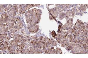 ABIN6273291 at 1/100 staining Human pancreas cancer tissue by IHC-P. (PDHB 抗体  (N-Term))