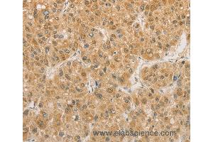 Immunohistochemistry of Human liver cancer using PGK2 Polyclonal Antibody at dilution of 1:50 (PGK2 抗体)