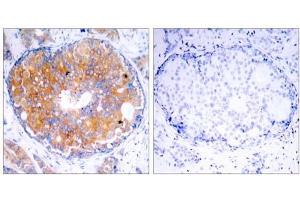 Immunohistochemical analysis of paraffin-embedded human breast carcinoma tissue using MEK2 (Ab-394) antibody (E021008). (MEK2 抗体)