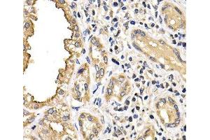 Immunohistochemistry of paraffin-embedded Human kidney cancer using ARRB2 Polyclonal Antibody at dilution of 1:200 (40x lens). (Arrestin 3 抗体)
