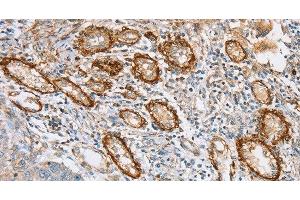 Immunohistochemistry of paraffin-embedded Human lung cancer tissue using CD108 Polyclonal Antibody at dilution 1:35 (SEMA7A 抗体)