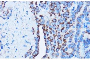 Immunohistochemistry of paraffin-embedded Human thyroid cancer using DDIT3 / CHOP Polyclonal Antibody at dilution of 1:100 (40x lens). (DDIT3 抗体)