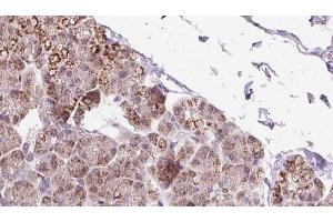 ABIN6273239 at 1/100 staining Human pancreas cancer tissue by IHC-P.