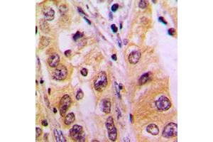 Immunohistochemical analysis of SURF1 staining in human liver cancer formalin fixed paraffin embedded tissue section. (SURF1 抗体  (Center))