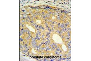 ZNF9 Antibody IHC analysis in formalin fixed and paraffin embedded prostate carcinoma followed by peroxidase conjugation of the secondary antibody and DAB staining. (CNBP 抗体  (AA 67-96))
