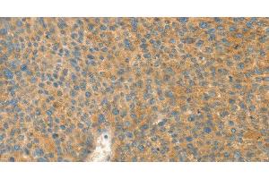 Immunohistochemistry of paraffin-embedded Human liver cancer tissue using AANAT Polyclonal Antibody at dilution 1:40 (AANAT 抗体)