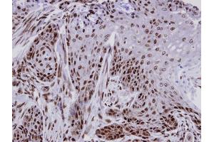 IHC-P Image Immunohistochemical analysis of paraffin-embedded Cal27 xenograft, using CTDP1 , antibody at 1:100 dilution. (CTDP1 抗体  (N-Term))