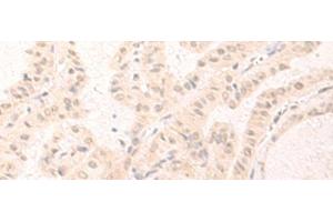 Immunohistochemistry of paraffin-embedded Human thyroid cancer tissue using IL7 Polyclonal Antibody at dilution of 1:30(x200) (IL-7 抗体)