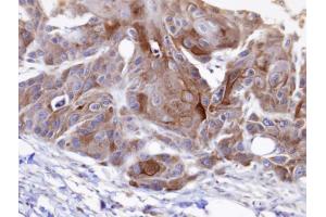 IHC-P Image Immunohistochemical analysis of paraffin-embedded SCC15 xenograft, using OSBPL6 , antibody at 1:100 dilution. (OSBPL6 抗体  (C-Term))
