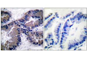 Immunohistochemical analysis of paraffin-embedded human lung carcinoma tissue, using NFE2L2 antibody (ABIN5976469). (NRF2 抗体  (C-Term))