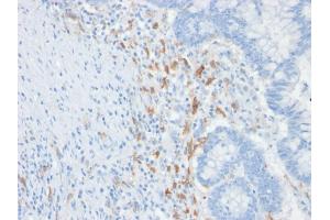 Formalin-fixed, paraffin-embedded human Colon Carcinoma stained with CD209 Mouse Monoclonal Antibody (C209/1781). (DC-SIGN/CD209 抗体)