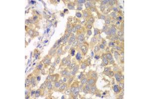Immunohistochemistry of paraffin-embedded human esophageal cancer using PFKM antibody (ABIN5973190) at dilution of 1/100 (40x lens). (PFKM 抗体)