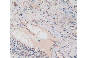 IHC-P analysis of Human Liver Cancer Tissue, with DAB staining. (Amphiregulin 抗体  (AA 20-100))