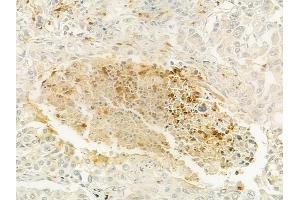 ABIN6259996 and ABIN6279132 at 1/100 staining human lung squamous cell carcinoma by IHC-P.