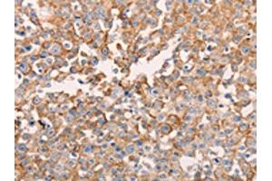 The image on the left is immunohistochemistry of paraffin-embedded Human breast cancer tissue using ABIN7129618(GNA11 Antibody) at dilution 1/40, on the right is treated with fusion protein. (GNA11 抗体)