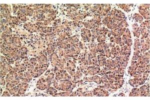 Immunohistochemistry of paraffin-embedded Human pancreas carcinoma tissue using CHOP Monoclonal Antibody at dilution of 1:200. (DDIT3 抗体)
