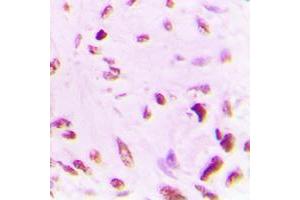 Immunohistochemical analysis of p53 (AcK381) staining in human lung cancer formalin fixed paraffin embedded tissue section. (p53 抗体  (acLys381, C-Term))