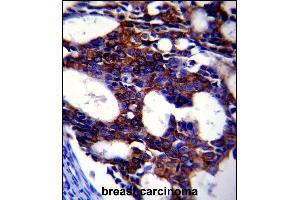 TGFB2 Antibody (ABIN659106 and ABIN2838086) immunohistochemistry analysis in formalin fixed and paraffin embedded human breast carcinoma followed by peroxidase conjμgation of the secondary antibody and DAB staining. (TGFB2 抗体)