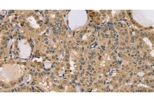 Immunohistochemistry of paraffin-embedded Human thyroid cancer using CENPV Polyclonal Antibody at dilution of 1:40 (CENPV 抗体)