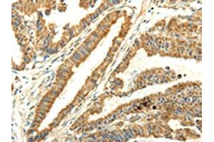 The image on the left is immunohistochemistry of paraffin-embedded Human esophagus cancer tissue using ABIN7128060(UBL4B Antibody) at dilution 1/25, on the right is treated with fusion protein. (UBL4B 抗体)